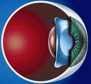 ICL晶体植入.jpg ICL晶体植入.jpg