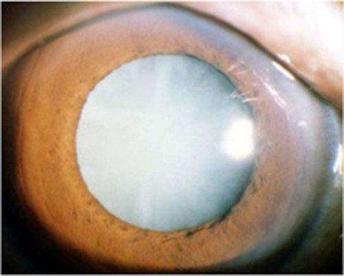 如何医治白内障.jpg 如何医治白内障.jpg
