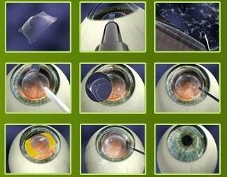 ICL晶体植入术.jpg ICL晶体植入术.jpg