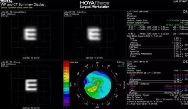 白内障手术已发展至屈光手术时代(一*次白内障屈光手术可解决白内障、老花眼、近视眼、远视眼、散光等多种眼病),手术 对于眼科医生来说变得更加容易,而术前准确的诊断、评估、测量和计算,为患者设计个性化的手术方案,成为白内障医生面对的难题。2.jpg 白内障手术已发展至屈光手术时代(一*次白内障屈光手术可解决白内障、老花眼、近视眼、远视眼、散光等多种眼病),手术 对于眼科医生来说变得更加容易,而术前准确的诊断、评估、测量和计算,为患者设计个性化的手术方案,成为白内障医生面对的难题。2.jpg