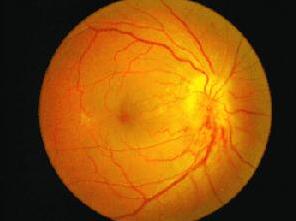 糖尿病除了引起心、脑、肾等全身多脏器损害，也引起多种眼病， 如：糖尿病性视网膜病变、白内障、新生血管性青光眼、视神经病变、葡萄膜炎、眼肌麻痹复视等。所以医生建议糖尿病患者要检查眼底。糖尿病患者应该定期去眼科检查.jpg