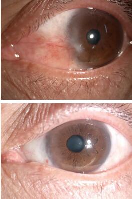 姚颖医生为文先生做了详细检查后,制定了左眼的翼状胬肉切除术、联合自体干细胞移植术、联合羊膜覆盖术的手术方案,这才为他解决了胬肉的麻烦与痛苦。手术一个月后,朋友见了文先生都说他的眼睛 了正常,看不出一点手术过的痕迹1.jpg 姚颖医生为文先生做了详细检查后,制定了左眼的翼状胬肉切除术、联合自体干细胞移植术、联合羊膜覆盖术的手术方案,这才为他解决了胬肉的麻烦与痛苦。手术一个月后,朋友见了文先生都说他的眼睛 了正常,看不出一点手术过的痕迹1.jpg