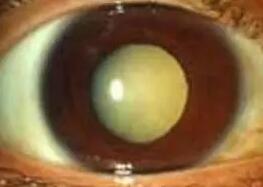 白内障.jpg 白内障.jpg