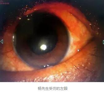 白内障和青光眼都是致盲性眼病,其中青光眼的病程不逆转。杨先生拖延伤情导致同时并发白内障、青光眼的情况,十分令人惋惜。”出名眼科专家、成都新利体育陈晓明教授表示2.jpg 白内障和青光眼都是致盲性眼病,其中青光眼的病程不逆转。杨先生拖延伤情导致同时并发白内障、青光眼的情况,十分令人惋惜。”出名眼科专家、成都新利体育陈晓明教授表示2.jpg