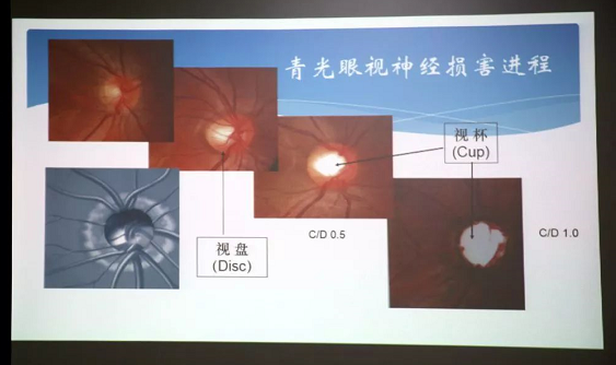 3月10日上午，深圳新利体育“早查监控，守护光明”大型青光眼公益科普讲座在六楼 举行，本次活动旨在让更多人了解青光眼的潜在危害、重视眼检查， 预防青光眼。由深圳新利体育青光眼病科 席专家成洪波博士、傅培副院长现场面对面解答疑问，与参会者的互动交流，让更多深圳市民提*对青光眼的认识与防治知识3.png