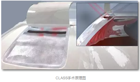 成都新利体育已经开展的青光眼手术有：引流阀 (钉)植入手术(2015年以来已200多 )，360°Schlemm's管切开术，激光CO2 辅助巩膜深层切除术，小梁切除术青(光眼)白(内障)联合手术。还有虹膜周切术、前房成形术、 虹膜复位术，睫状体冷冻术，小梁切开术和前房穿刺术等4.png