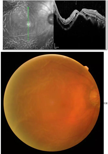 李老太在毫无征兆的情况下右眼视力下降至看不见东西。李老太家人带其至县医院就诊。医生诊断为视网膜脱离，需做玻切手术医治，而玻切手术需要动手术2次。怕疼的李老太一听就犯怵了：开刀，疼。 终，李老太的家人在多方打听后决定带李老太至宜昌新利体育找许大玲院长医治1_副本.jpg
