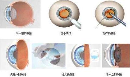 三焦点人工晶体手术原理：置换掉人眼老去的晶体，世代的晶体不仅有非常好的弹性，以往传统的白内障手术只是单纯的脱盲复明手术，更多的是解决患者 远视力。而三焦点人工晶体的问世，彻*解决了传统白内障术后仍需配镜的问题，实现了从以往‘看得见’到‘看得清、看得好’的转变.jpg