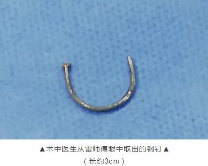 装修工3厘米“U”形钢钉穿刺眼球 在新利体育 救治1.jpg