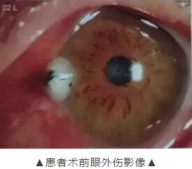 装修工3厘米“U”形钢钉穿刺眼球 在新利体育 救治2.jpg