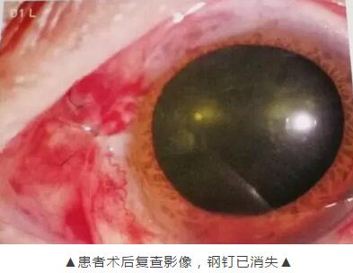 装修工3厘米“U”形钢钉穿刺眼球 在新利体育 救治4.jpg