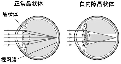 白内障应早做复明手术1.png 白内障应早做复明手术1.png
