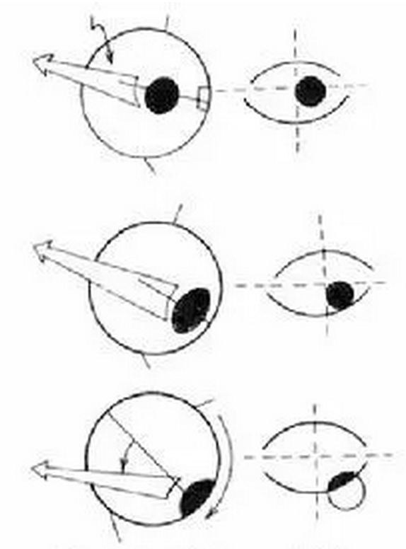眼球后退综合症的类型与医治方式1.png 眼球后退综合症的类型与医治方式1.png