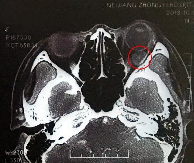 成都新利体育罗清礼教授为眼眶肿瘤患者顺利进行手术1.jpg 成都新利体育罗清礼教授为眼眶肿瘤患者顺利进行手术1.jpg