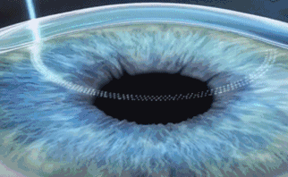 想要当兵视力不达标怎么办?新利体育有这些摘镜术式帮助你2.gif 想要当兵视力不达标怎么办?新利体育有这些摘镜术式帮助你2.gif