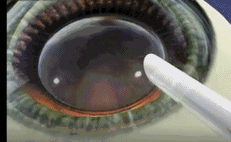 想要当兵视力不达标怎么办?新利体育有这些摘镜术式帮助你3.gif 想要当兵视力不达标怎么办?新利体育有这些摘镜术式帮助你3.gif