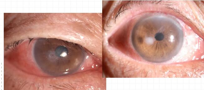 重庆老头角膜穿刺后在新利体育修补并进行白内障手术.jpg 重庆老头角膜穿刺后在新利体育修补并进行白内障手术.jpg