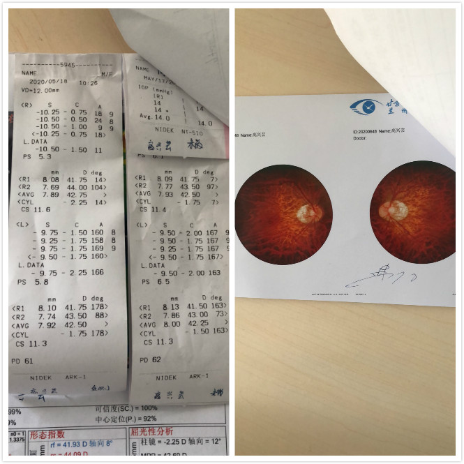 兰州激光医治近视 兰州激光医治近视