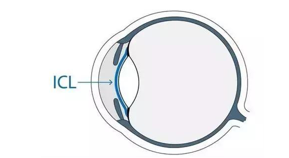 在杭州新利体育高度近视手术后,近视2550度配不到眼镜的四川大哥,看清了!4.png 在杭州新利体育高度近视手术后,近视2550度配不到眼镜的四川大哥,看清了!4.png