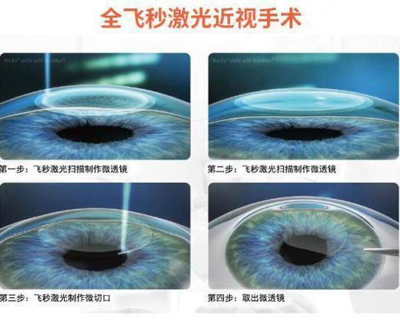 菏泽新利体育近视手术王2.png