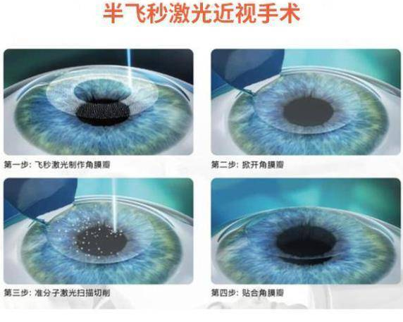 菏泽新利体育近视手术王3.png