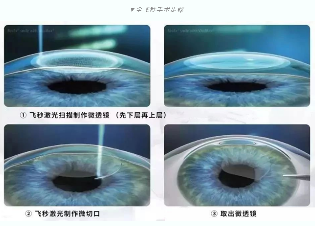 7月26日来深圳新利体育参与暑期摘镜季活动就可以有机会参与抽奖免单手术!2.png 7月26日来深圳新利体育参与暑期摘镜季活动就可以有机会参与抽奖免单手术!2.png