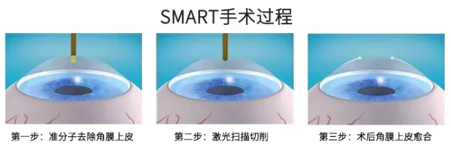 高考毕业后做近视手术,如今近视手术有了越来越高的安全性,且多样的术式可以满足不同患者的摘镜需求。2.png 高考毕业后做近视手术,如今近视手术有了越来越高的安全性,且多样的术式可以满足不同患者的摘镜需求。2.png