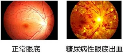 糖尿病为什么会损害眼睛11.28快来听福州眼科医院陈平院长怎么说1.png 糖尿病为什么会损害眼睛11.28快来听福州眼科医院陈平院长怎么说1.png