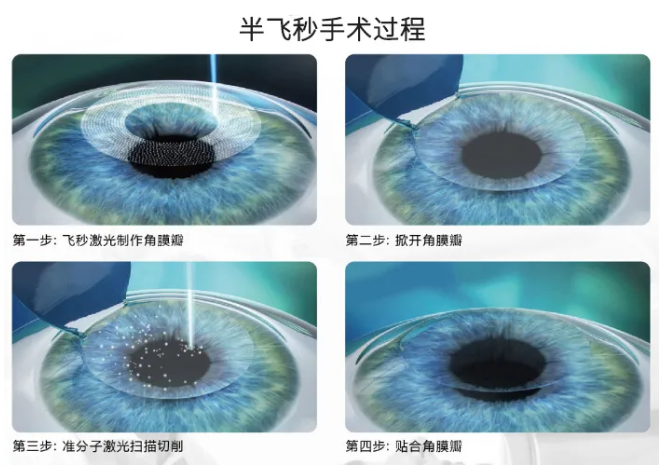 2021年征兵时间已定,参加征兵近视青年需尽快做近视手术2.png 2021年征兵时间已定,参加征兵近视青年需尽快做近视手术2.png