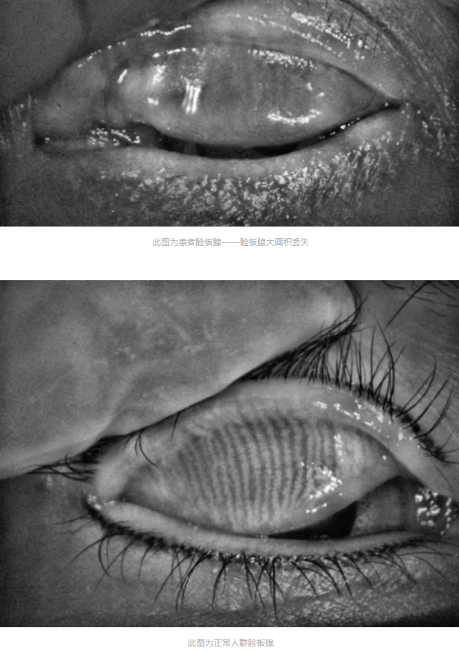 寺院住持来安徽理工大附属眼科医院(淮南新利体育)做干眼医治3.png 寺院住持来安徽理工大附属眼科医院(淮南新利体育)做干眼医治3.png